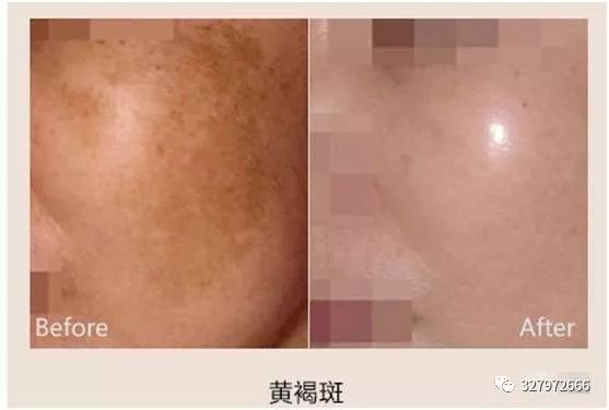 脸上色斑越来越多该怎么淡化色斑,色斑的解决方案