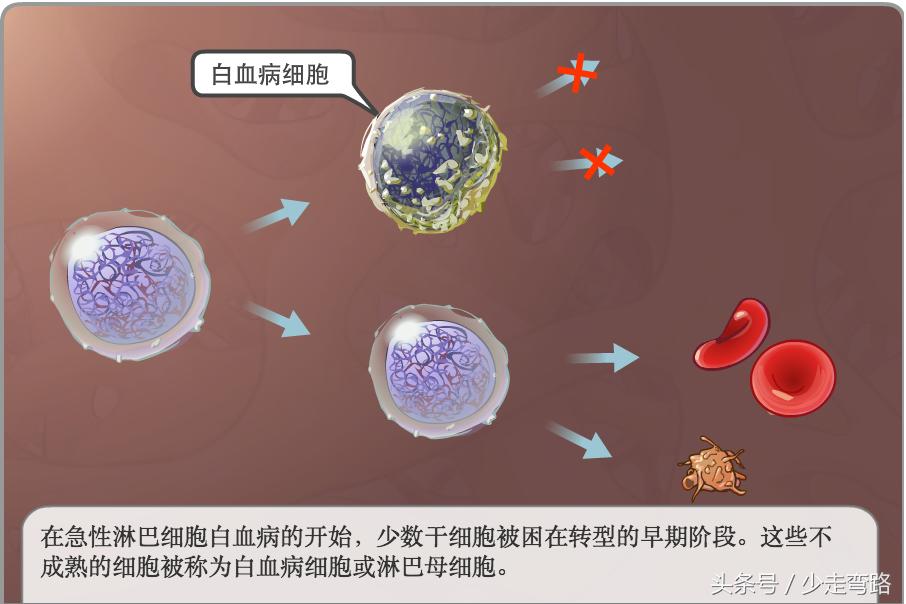 急性淋巴细胞白血病定义,小儿急性淋巴细胞性白血病