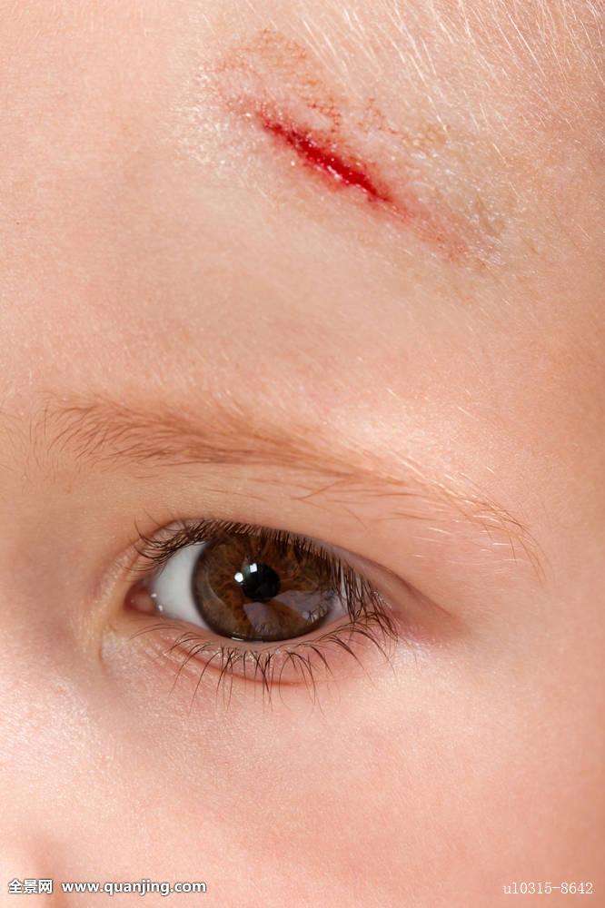 宝宝抓破皮流脓怎么处理,宝宝手被蹭破皮了要不要打破伤风