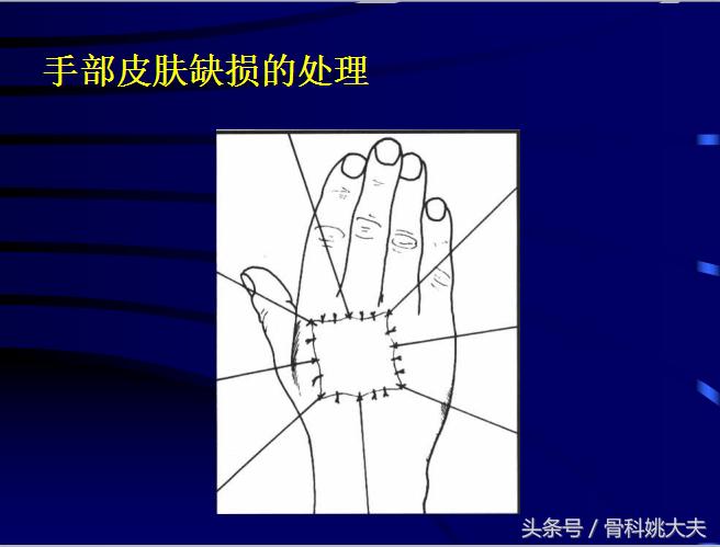 手肌腱损伤图片,手外伤神经肌腱损伤怎么定残