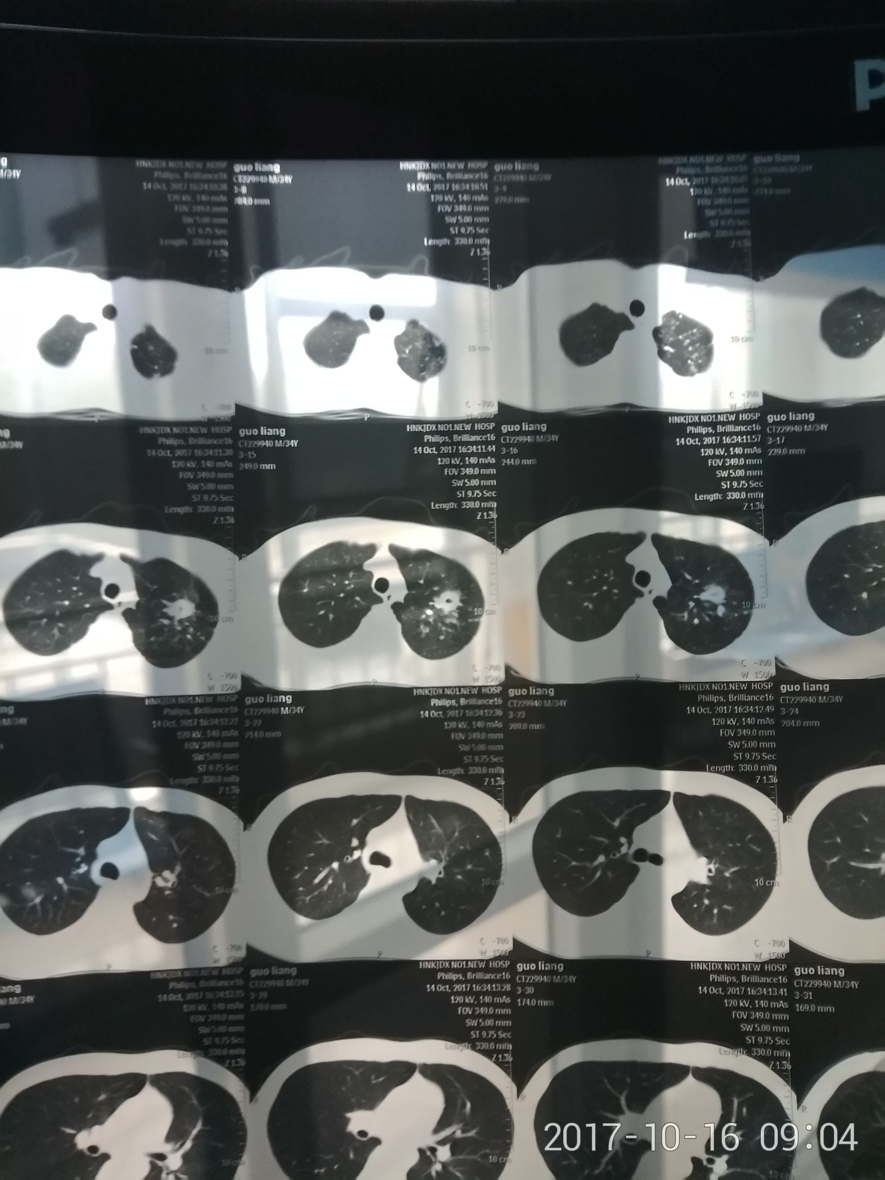 抗核日记：一个肺结核患者的治疗过程㈠
