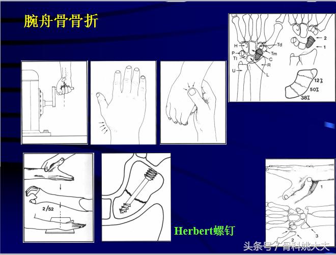 手肌腱损伤图片,手外伤神经肌腱损伤怎么定残