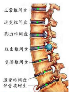 怎样正确认识腰椎几节,正确认识腰椎