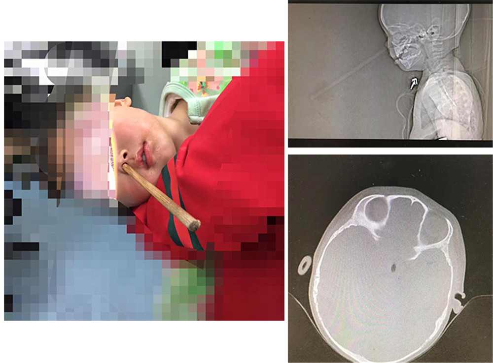 小孩吃饭不谨慎把筷子插到喉咙,孩子吃饭拿筷子插入鼻子
