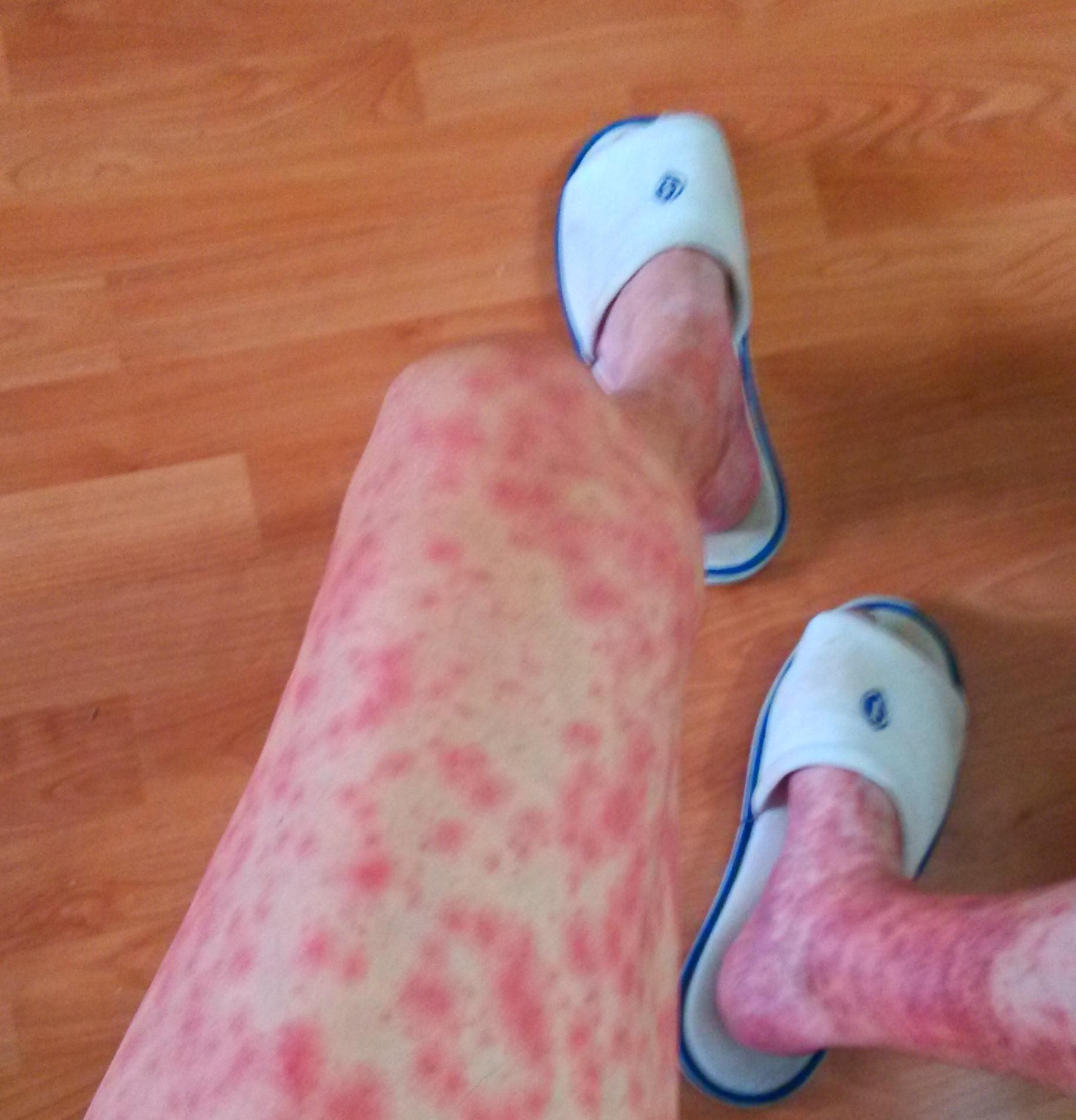 中美联手成功案例,双安联合治疗肝癌