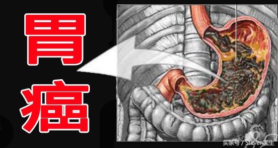 入职体检幽门螺旋杆菌影响入职么,体检哪项指标可以看幽门螺旋杆菌