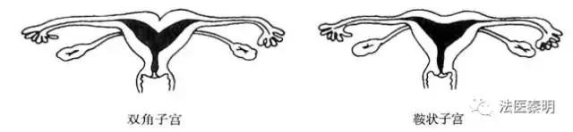 女人有两个子宫怎么办,有两个子宫怎么治疗