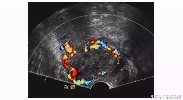 瘢痕妊娠的三维彩色超声图像,内生型瘢痕妊娠超声诊断标准
