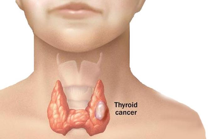 快被癌症家族扫地出门的甲状腺癌：高发却温和10年存活率可达90%