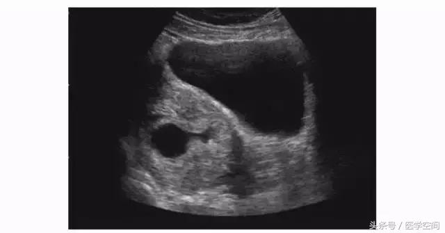 瘢痕妊娠的三维彩色超声图像,内生型瘢痕妊娠超声诊断标准