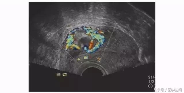 瘢痕妊娠的三维彩色超声图像,内生型瘢痕妊娠超声诊断标准