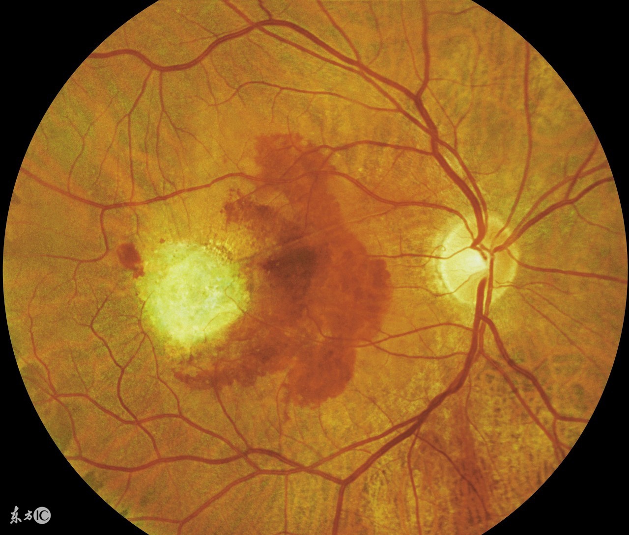 小褐斑怎么办,预防褐斑的最佳方法