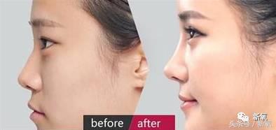 韩安冉这次鼻子修复是在哪修复的,韩安冉现在做的鼻子是什么款的