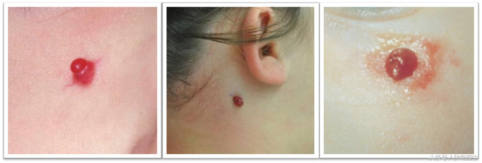 血管瘤系列科普之四，肉芽肿性血管瘤