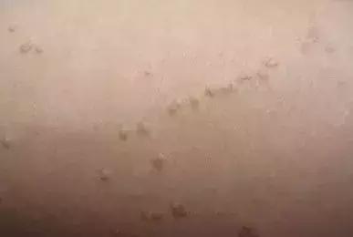 身上起了很多小疙瘩是扁平疣吗,皮肤上长了小米粒大的疙瘩是什么