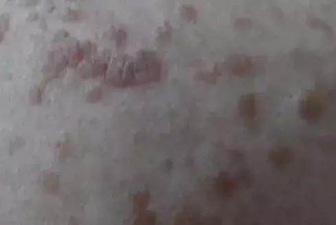 身上起了很多小疙瘩是扁平疣吗,皮肤上长了小米粒大的疙瘩是什么