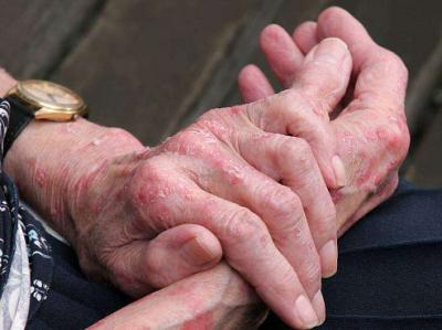 皮肤过敏查过敏源多少钱,皮肤过敏怎么测过敏源