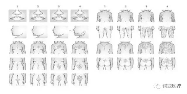 肥胖导致内分泌失调月经紊乱,月经不规律多毛怎么办