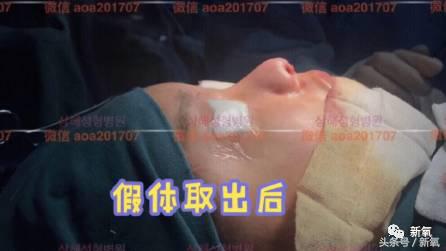 韩安冉这次鼻子修复是在哪修复的,韩安冉现在做的鼻子是什么款的