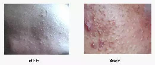 身上起了很多小疙瘩是扁平疣吗,皮肤上长了小米粒大的疙瘩是什么