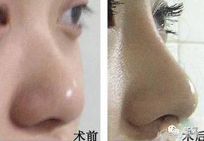 韩安冉这次鼻子修复是在哪修复的,韩安冉现在做的鼻子是什么款的