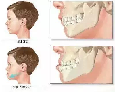 宝宝地包天应如何防治,宝宝出现地包天怎么办