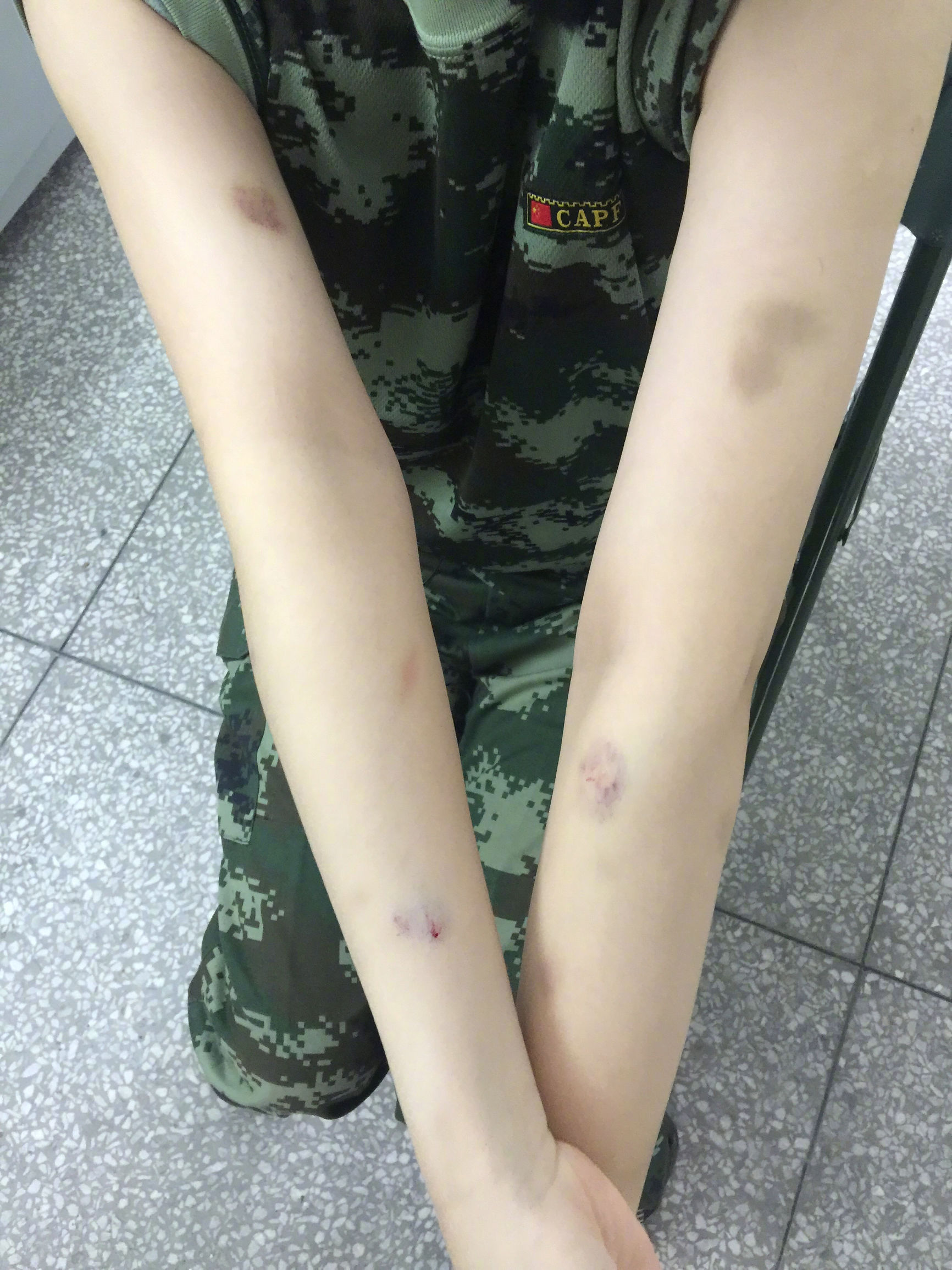 张馨予被狗咬的是哪个节目,张馨予为什么被狗咬伤