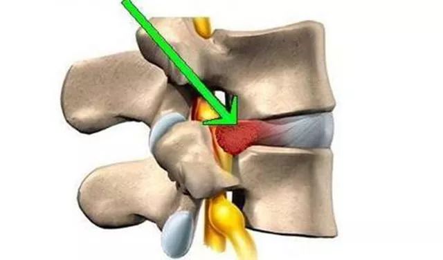 腰椎间盘突出症讲究长期缓解，无任何方法可保证不复发！