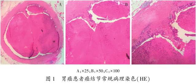 癌结节,胃癌伴巨大癌结节