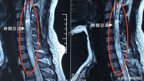 脊髓空洞症的治疗多少钱,脊髓空洞症的治疗费用多少