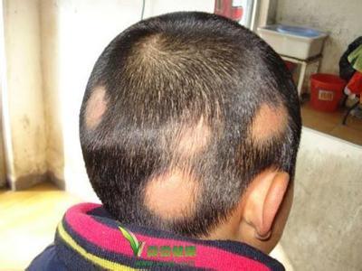 为考名园压力大2.5岁毛毛长斑秃