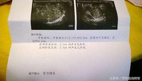 孕囊大小能判断双胎,孕囊大小看d1还是d2