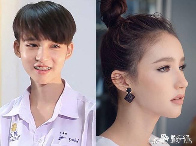 爱美戴牙套导致整排牙齿脱落！看着都疼！泰国医生发文警示