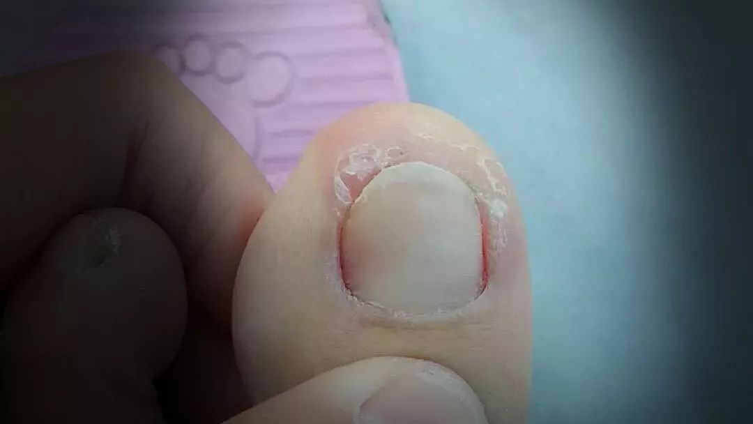 脚趾甲边缘起白皮,脚趾甲边缘上有黑块是什么原因