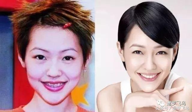 爱美戴牙套导致整排牙齿脱落！看着都疼！泰国医生发文警示