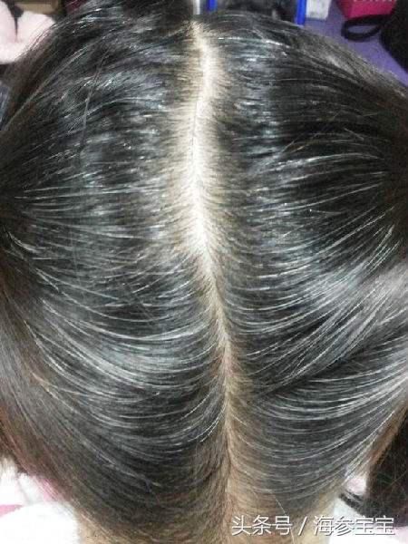 学习压力大，孩子长了白头发怎么办？一些小知识教你如何应对