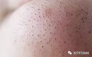黑头痘痘粉刺去除过程护理,巨大粉刺型痘痘怎么治疗