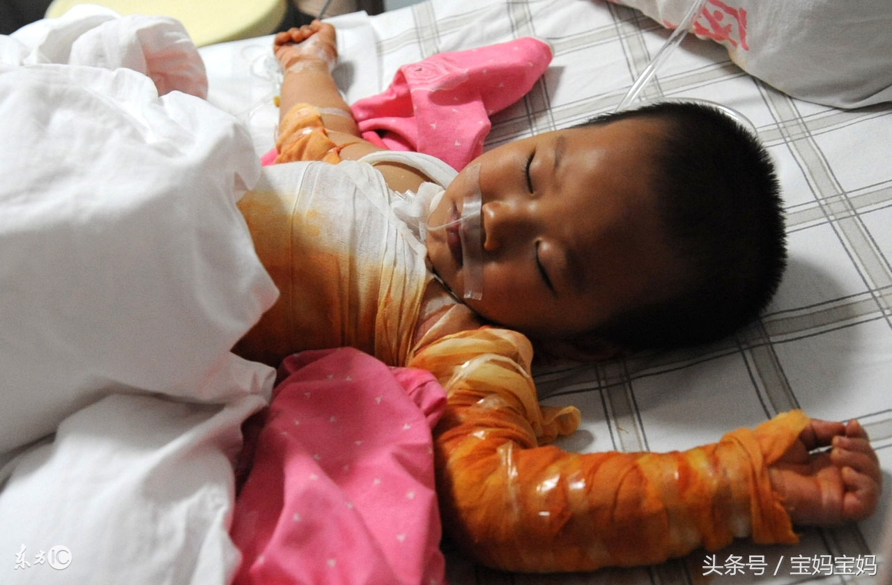 宝宝烫伤了怎么办？烫伤怎么避免和处理？