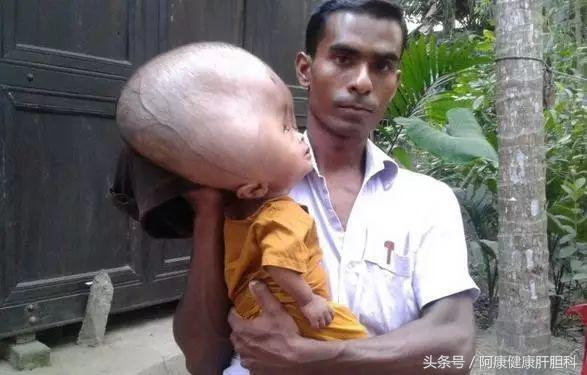 人血白蛋白治疗水肿原理,人血白蛋白对肺部水肿有用吗