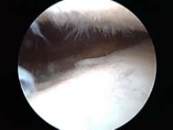 膝关节损伤肿胀的消除方法,关节肿胀完全消除