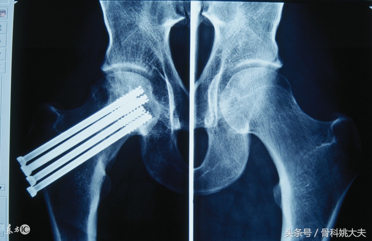 有外伤的骨折一个半月了还没愈合,同样的骨折有人几个月愈合