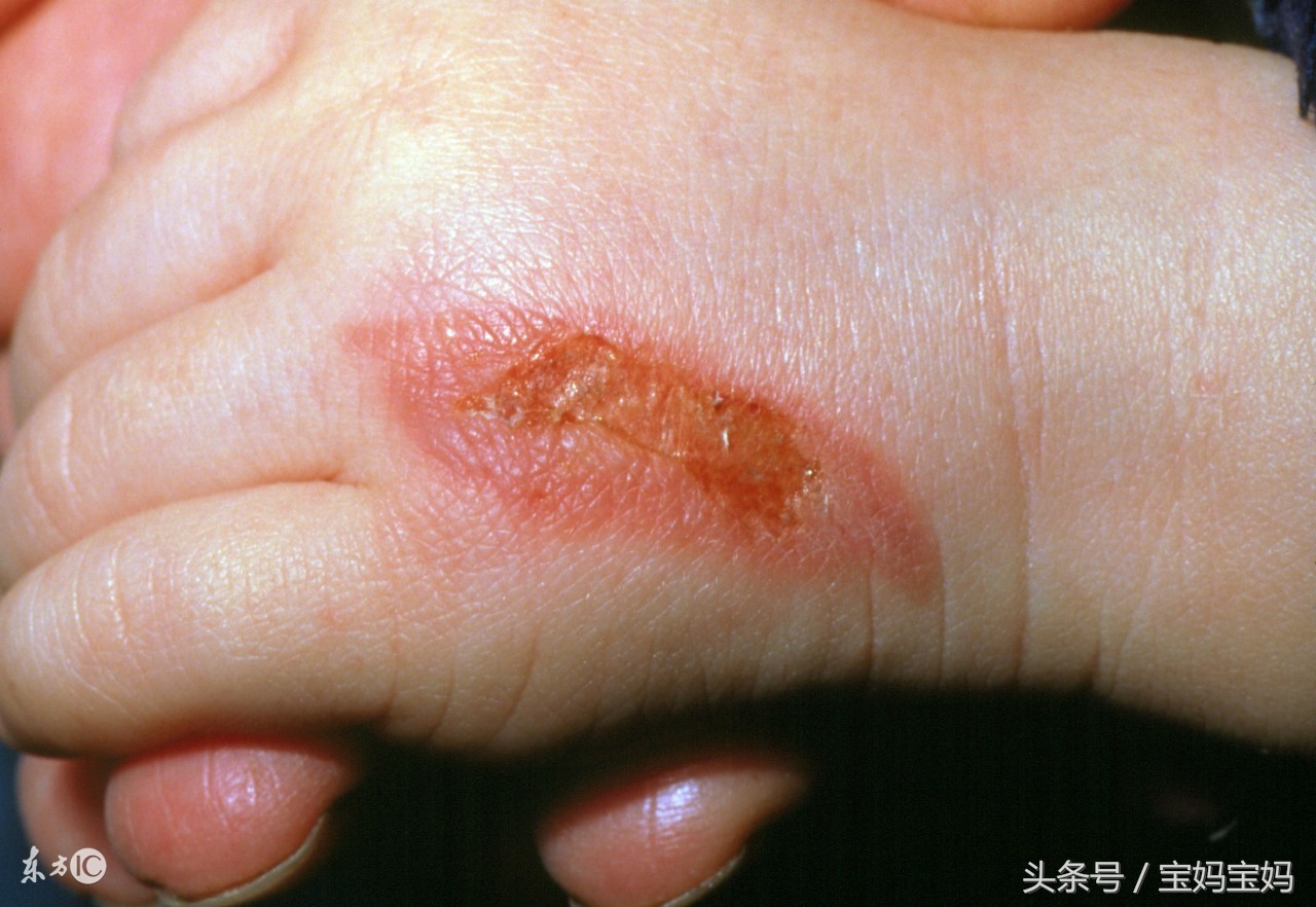宝宝烫伤了怎么办？烫伤怎么避免和处理？