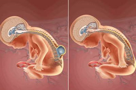 先天性脊柱裂可以治疗吗,脊柱裂怎么治疗