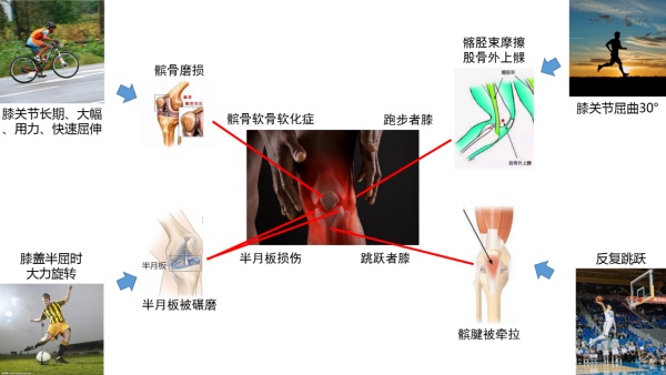 膝关节损伤肿胀的消除方法,关节肿胀完全消除