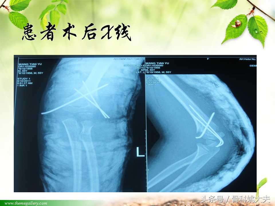 儿童肱骨干骨折处理方法,小孩胳膊肱骨骨折恢复最佳的方法
