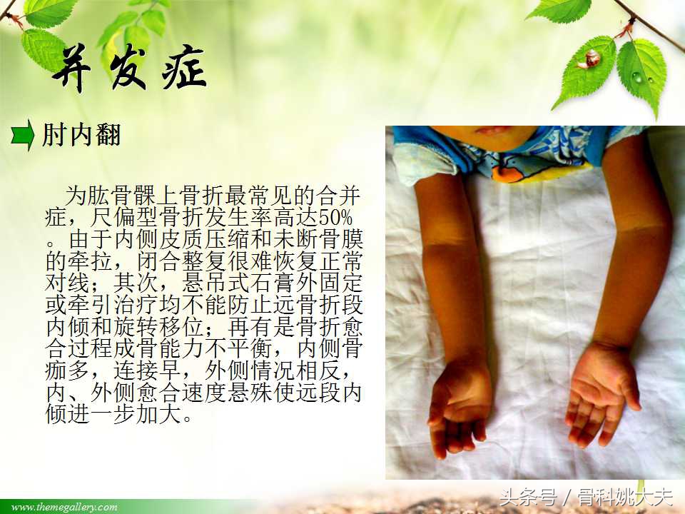 儿童肱骨干骨折处理方法,小孩胳膊肱骨骨折恢复最佳的方法