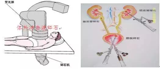 对尿结石有帮助的产品,尿路结石神器