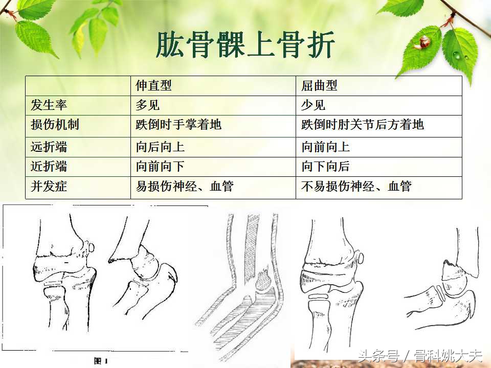 儿童肱骨干骨折处理方法,小孩胳膊肱骨骨折恢复最佳的方法
