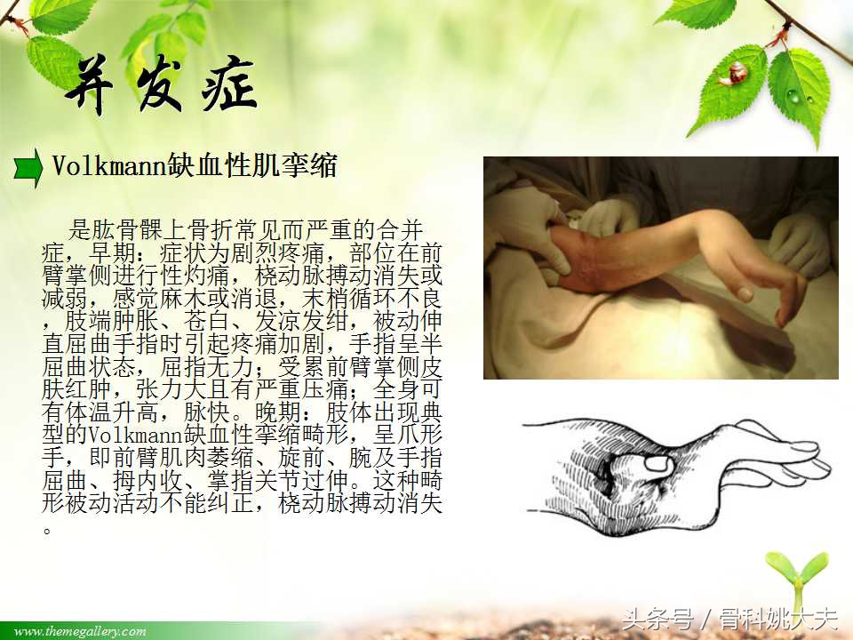 儿童肱骨干骨折处理方法,小孩胳膊肱骨骨折恢复最佳的方法