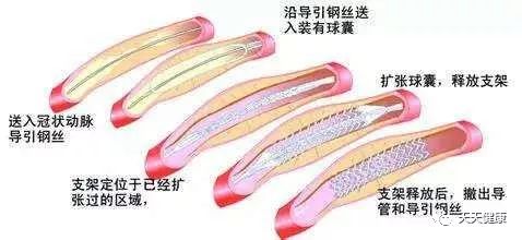 冠心病介入治疗是什么,安贞医院冠心病介入治疗新技术